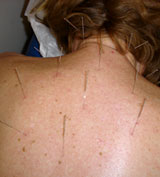 back pain acupuncture houston