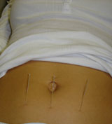 diabetes acupuncture