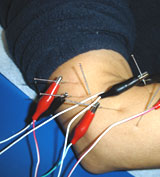 Electro-acupuncture